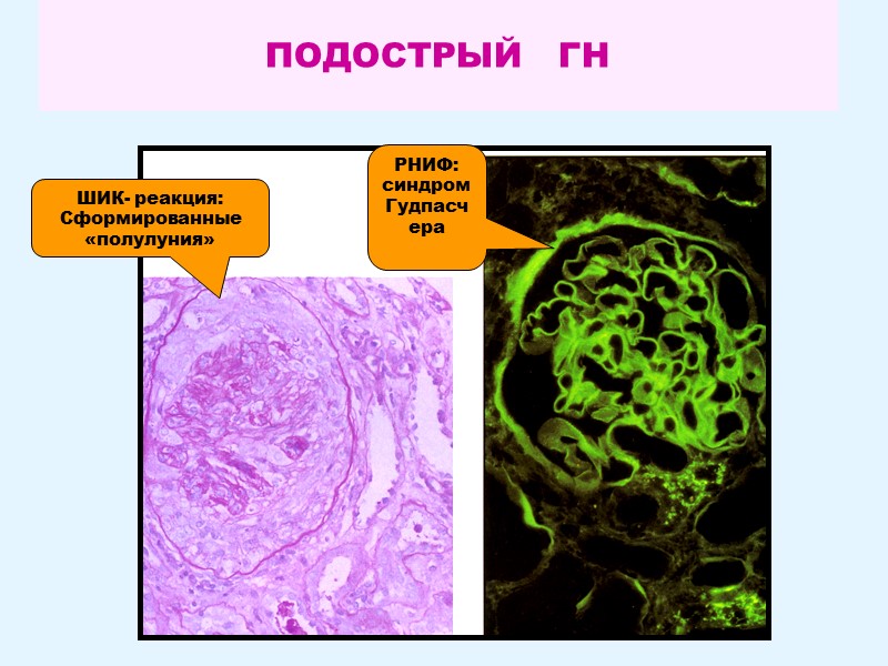 ПОДОСТРЫЙ   ГН ШИК- реакция: Сформированные «полулуния» РНИФ: синдром Гудпасчера